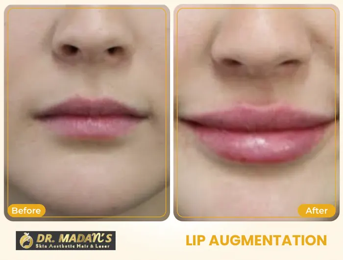Lip augmentation before and after result 4 at Dr Madan Aesthetics